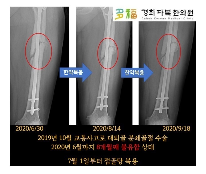 치골골절, 한약회복 사례